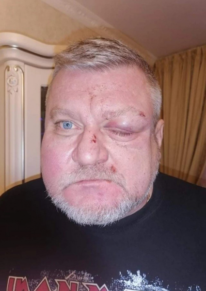 В Херсоне из-за замечания избили депутата: фото