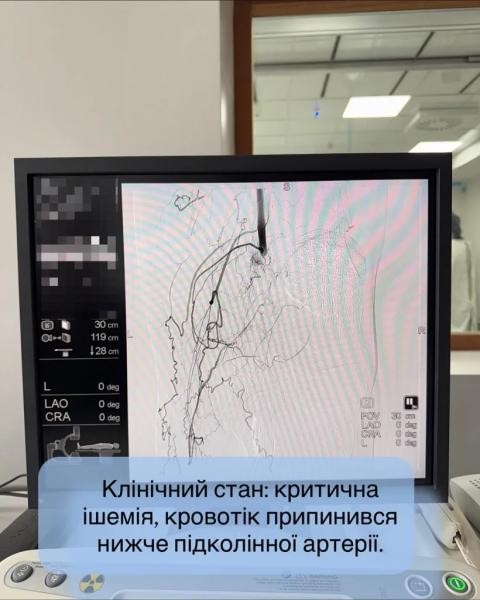 Кінцівка &laquo;ожила&raquo; на операційному столі: у Нововолинську медики врятували ногу пацієнта від ампутації | Новини Нововолинська